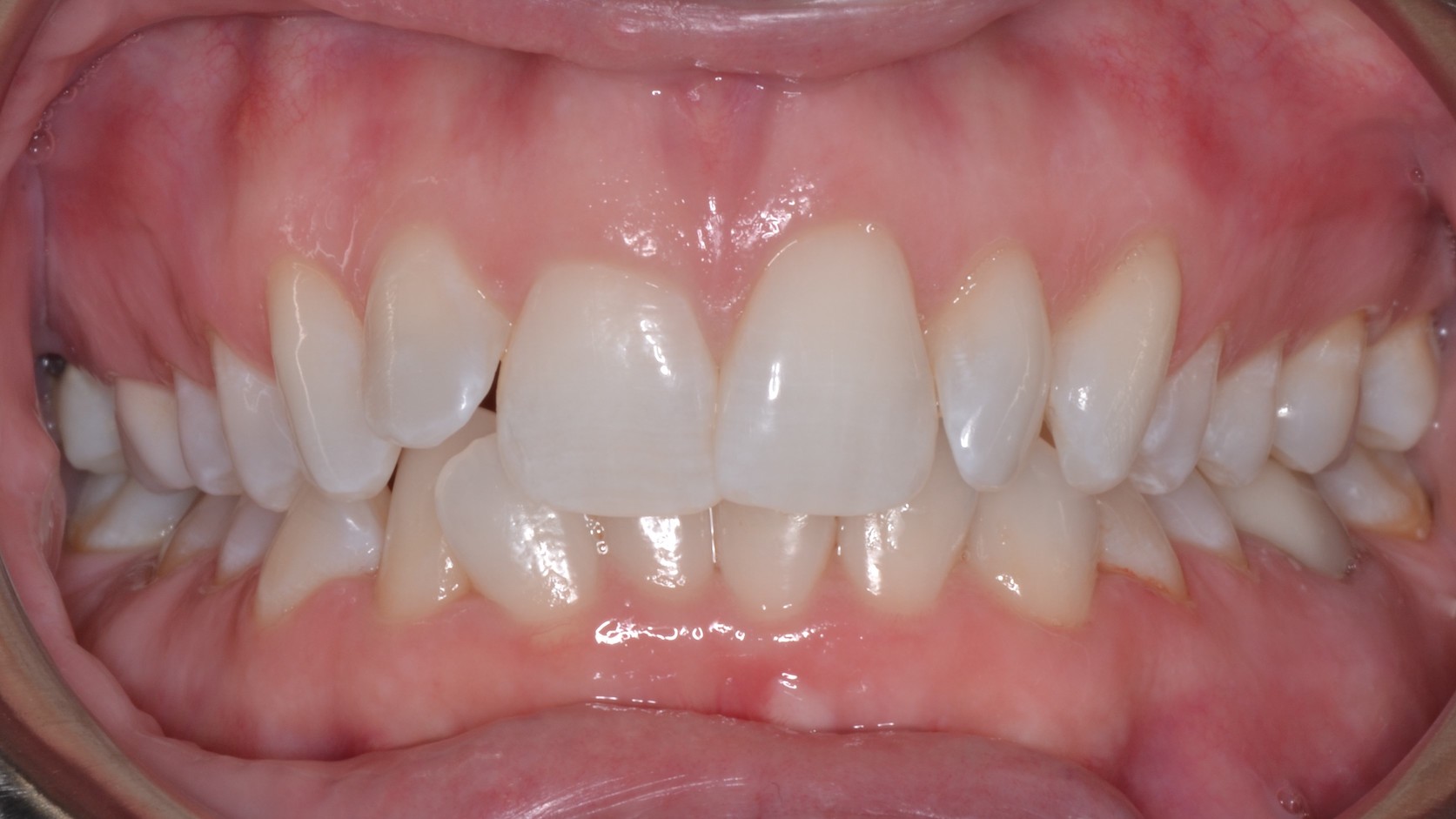 Dental Crowns Teeth Before Louisville Kentucky