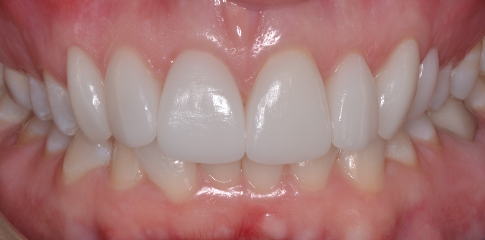 Dental Crowns Teeth After Louisville Kentucky