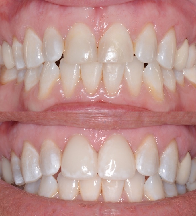 Dental Crowns Teeth After Louisville Kentucky