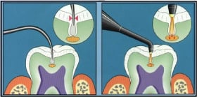 DIAGNOdent Laser Cavity Detector Illustration Dental Louisville Kentucky