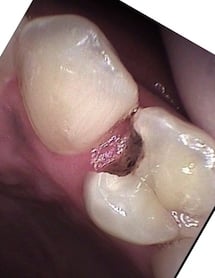 Dental Tooth-Colored Fillings Before Louisville Kentucky