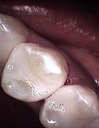 Dental Tooth-Colored Fillings After Louisville Kentucky