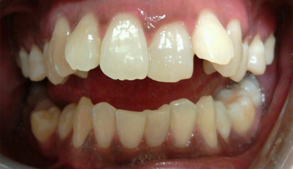 Dental Short Term Orthodontics Adult Cosmetic Braces Before Louisville Kentucky