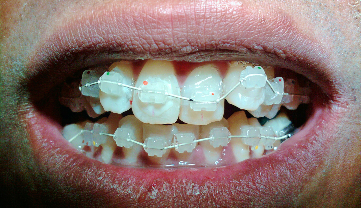 Dental Short Term Orthodontics Adult Cosmetic Braces During Louisville Kentucky