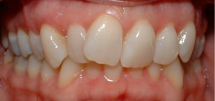 Dental Short Term Orthodontics Adult Cosmetic Braces Before Louisville Kentucky