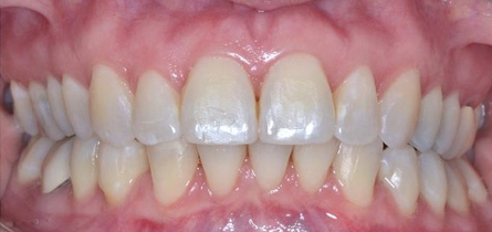 Dental Short Term Orthodontics Adult Cosmetic Braces After Louisville Kentucky