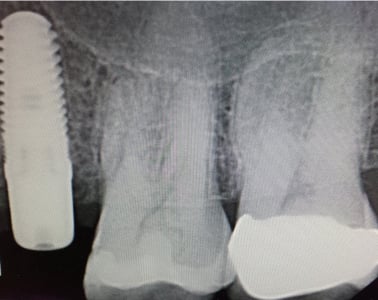 Digital X-Rays Radiographs Implants Placement Dentist Louisville Kentucky
