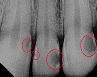 Digital X-Rays Radiographs Cavity Dentist Louisville Kentucky